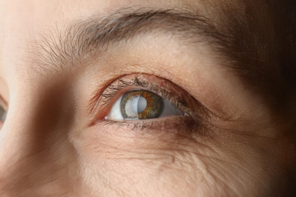 Close up of a cataract in an eye