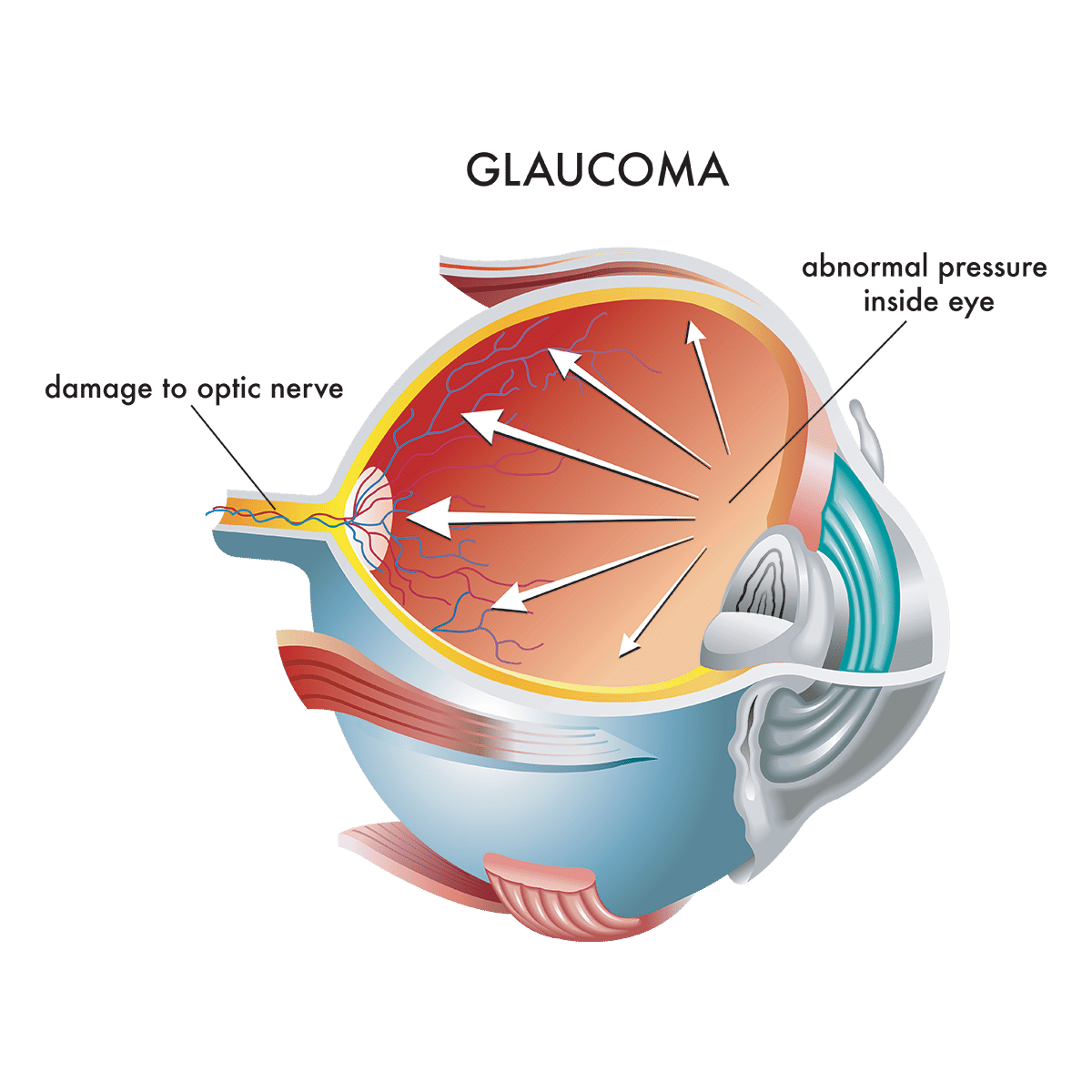 Glaucoma Wooster | Glaucoma Treatment | Wooster Eye Center